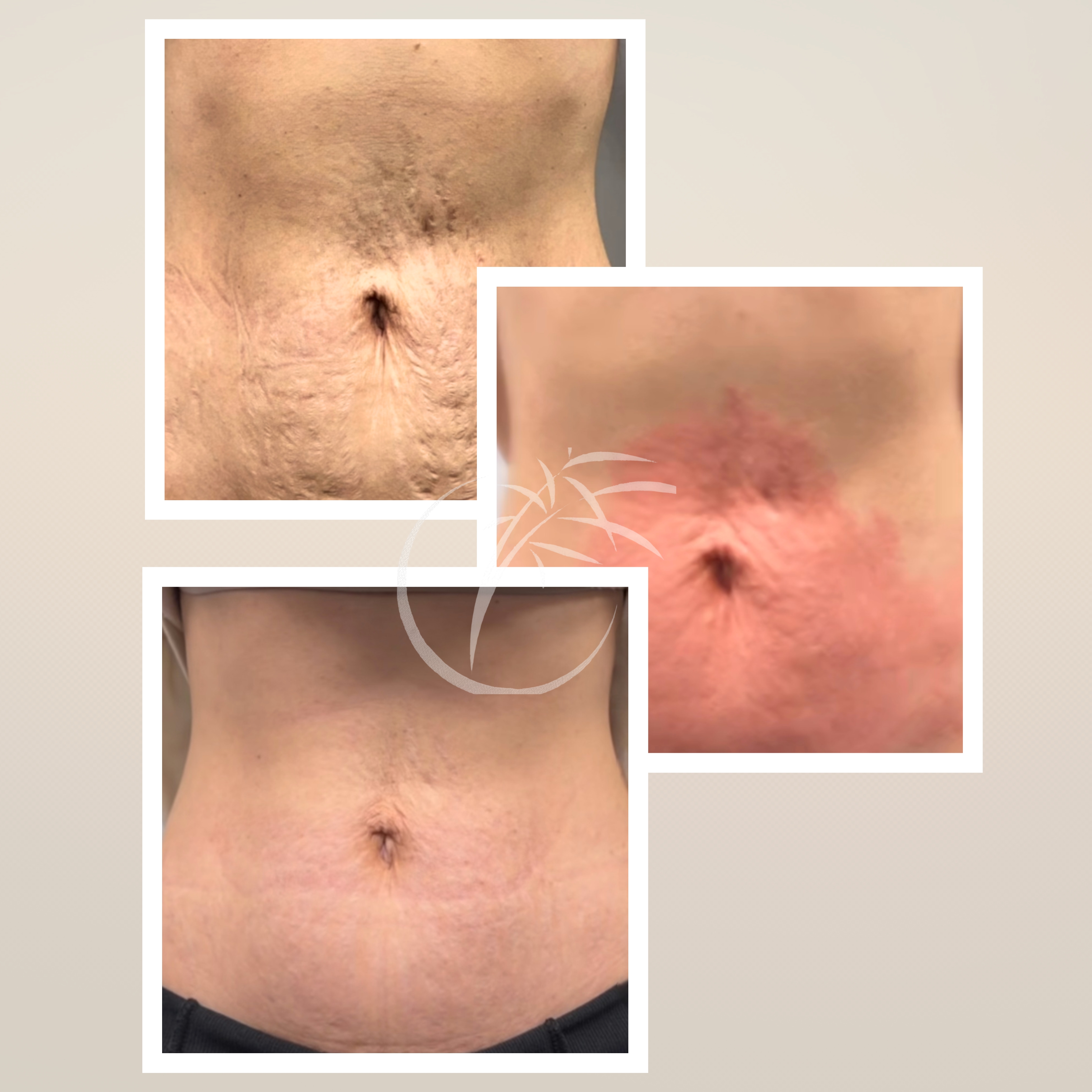 BioRéPeel Body · Inkless Kombi
