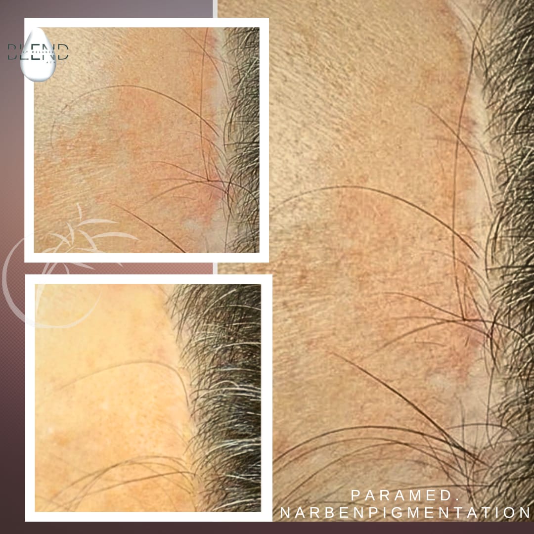 Paramedizinische Dermapigmentierung — Behandlung close-up