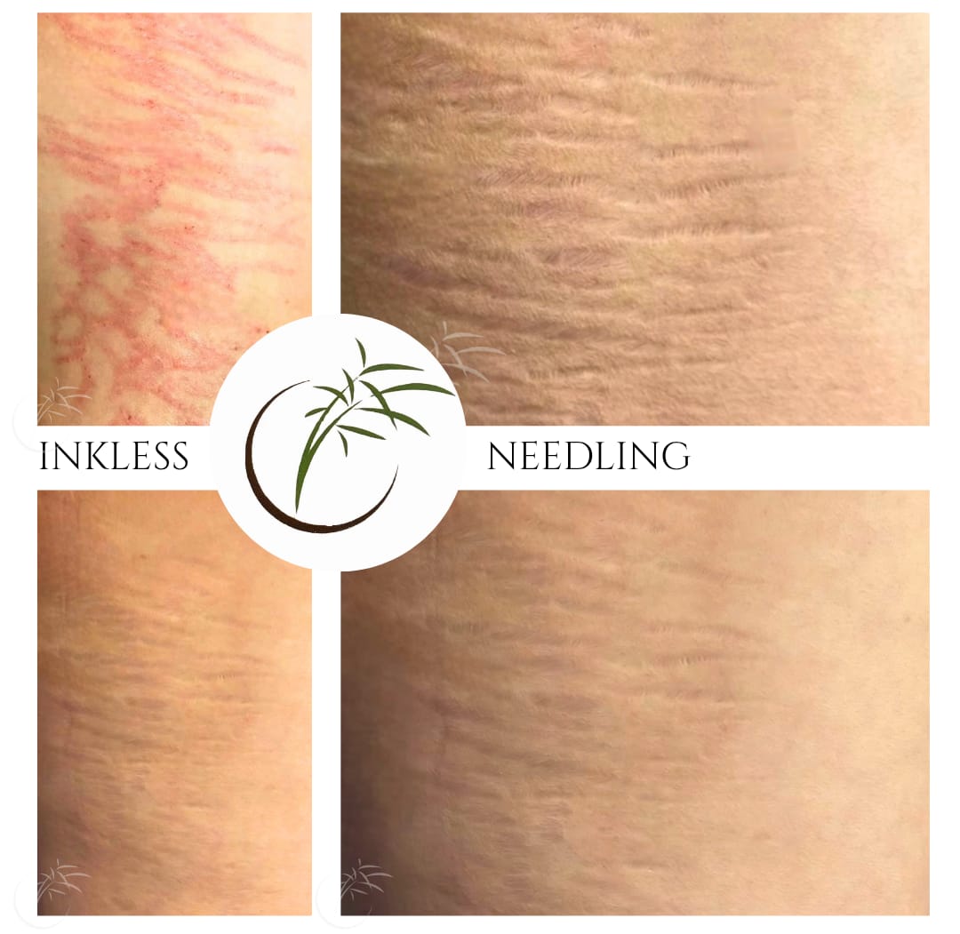 Inkless Needling · Dehnungsstreifen