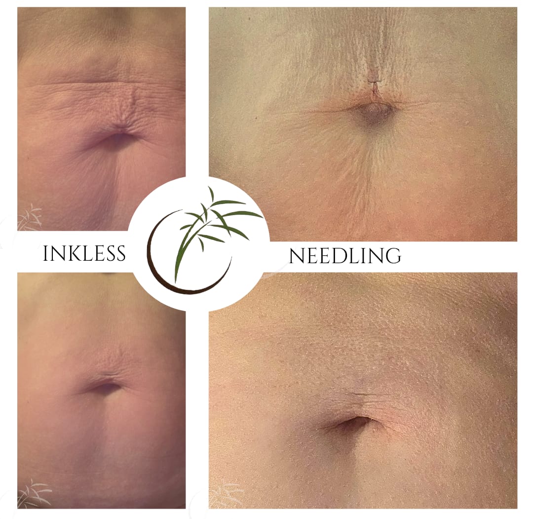 Inkless Needling · Dehnungsstreifen