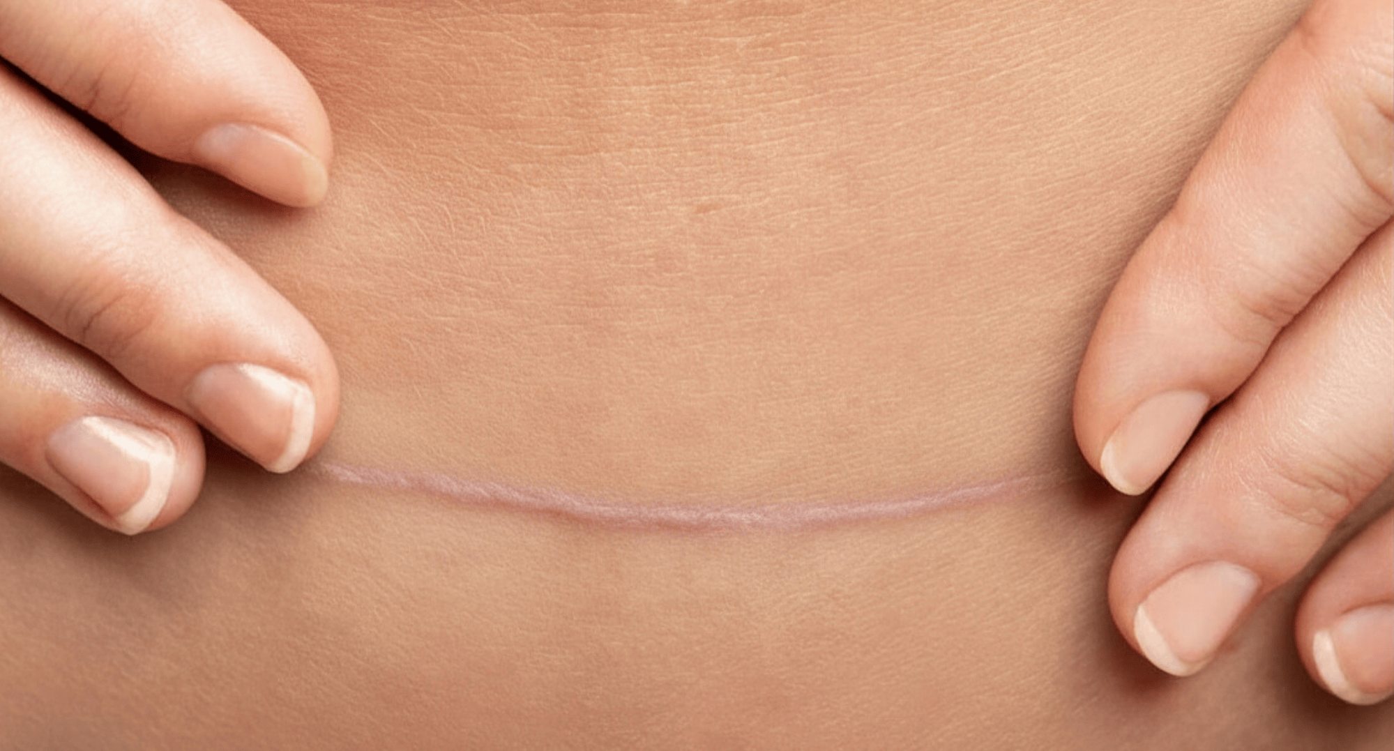 Bauchnarbe mit Händen — paramedizinische Dermapigmentierung