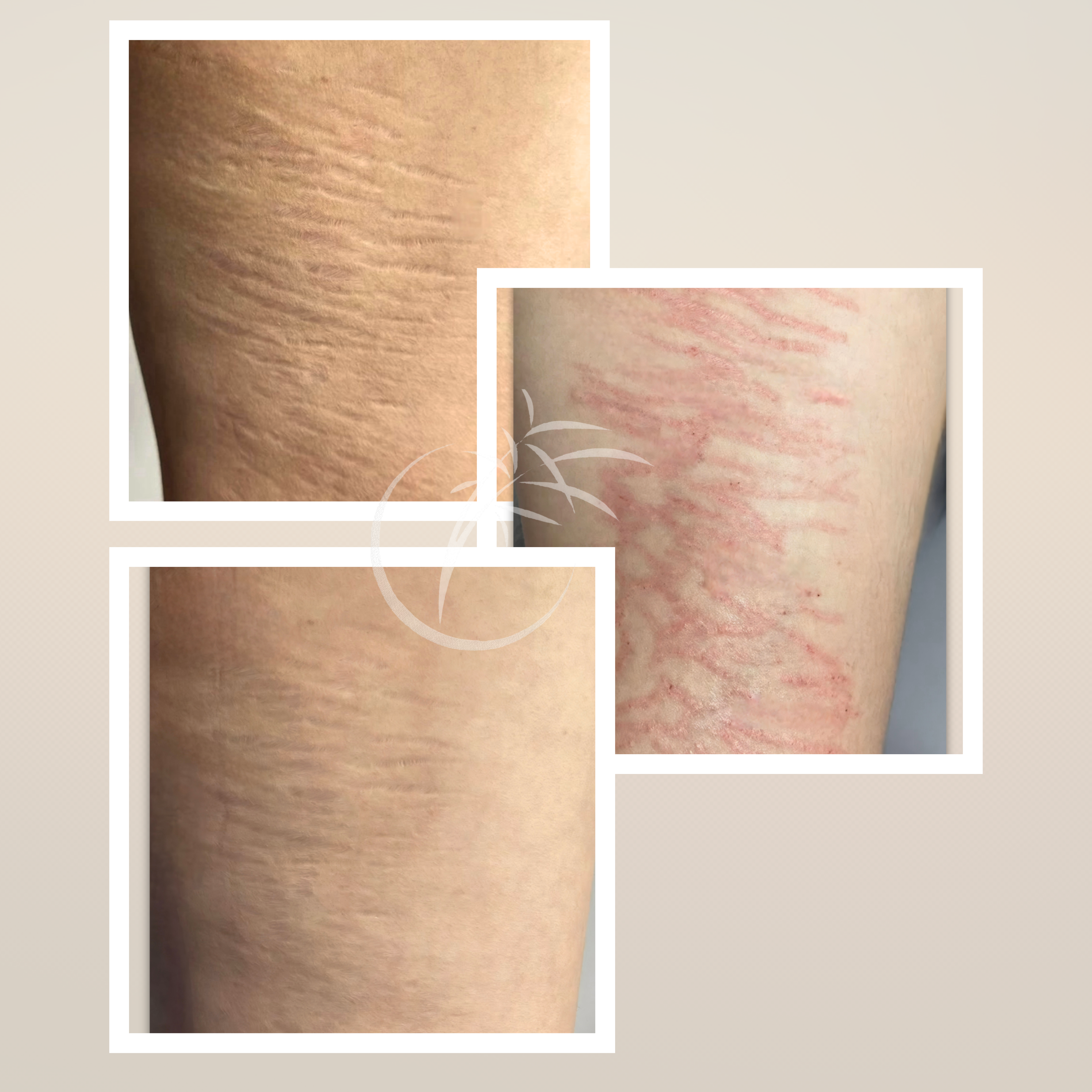 Inkless Needling · Mit Aktivserum