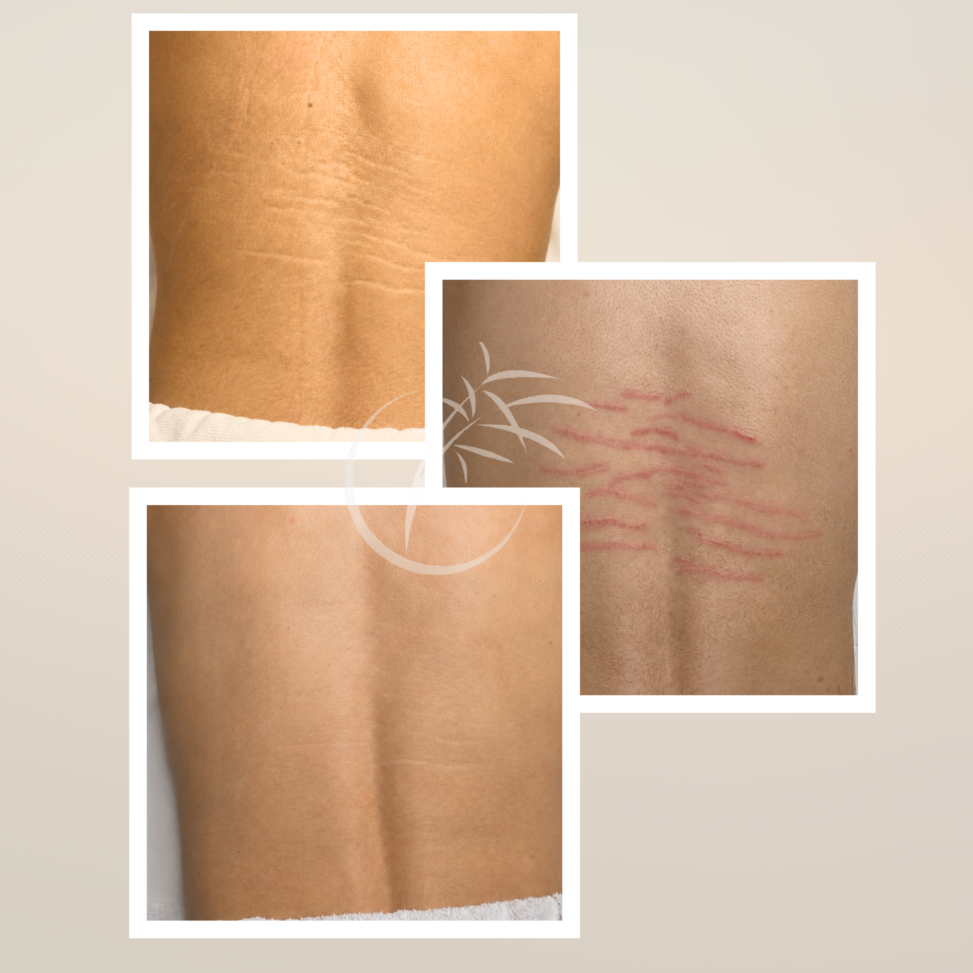 Inkless Needling · Pur